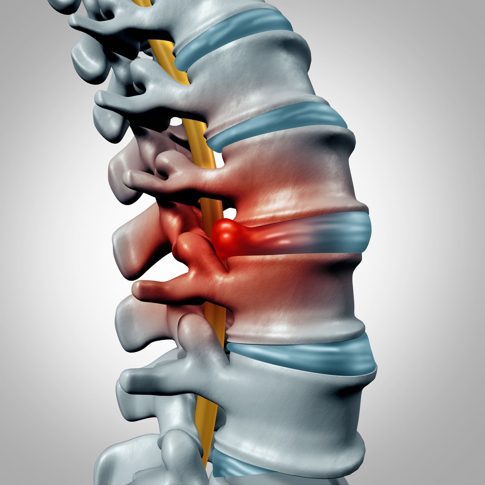 Sciatica Relief Program